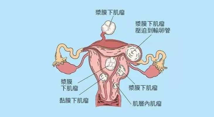 杨浦助孕神州中泰比较好_崇左45岁做试管婴儿检查发现子宫长了瘤子，能不做手